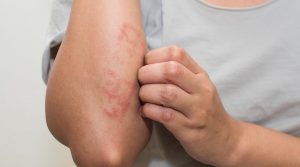 Treatment of Lichen Planus in Ayurveda