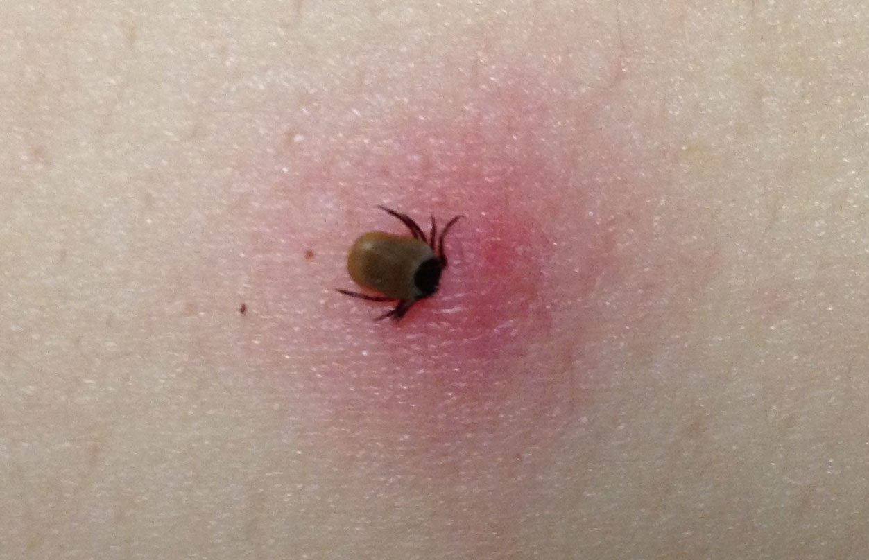 Ayurvedic Treatment for Lyme Disease Symptoms And Diagnosis