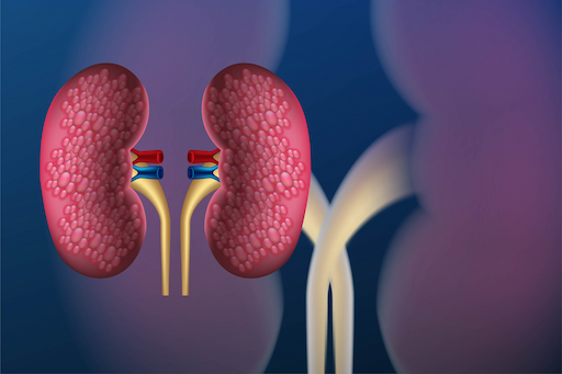 Ayurveda Treatment for kidneystone