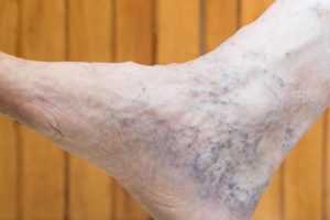 A leg with varicose vein