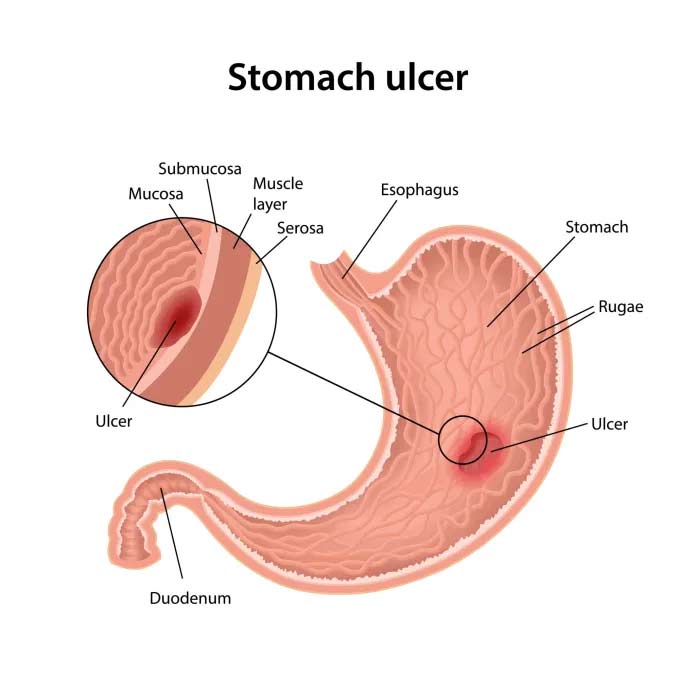 Ulcer Treatment Ayurveda