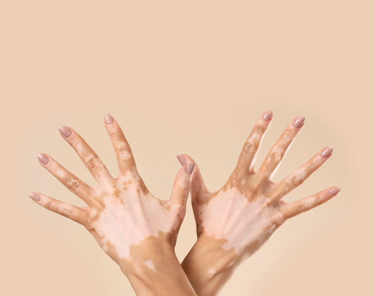 Vitiligo Treatment in Ayurvedic