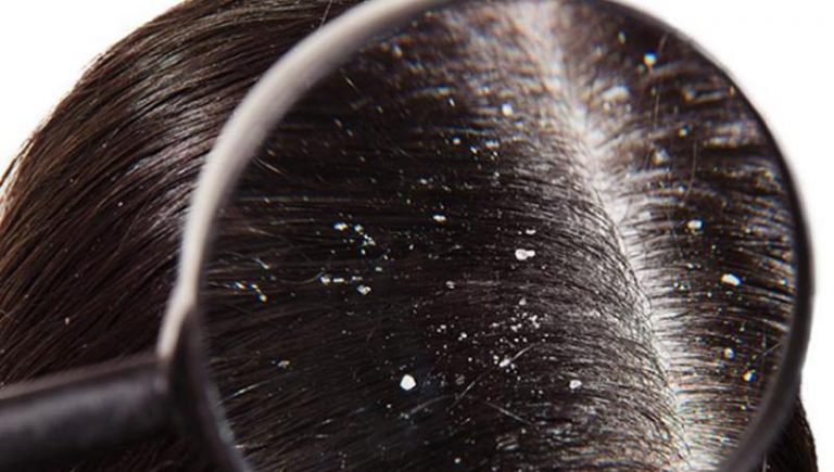 Ayurveda Treatment for Dandruff