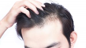 Ayurveda treatment for hair loss