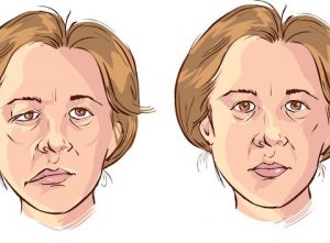 Myasthenia Gravis