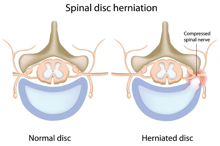 Slipped Disc