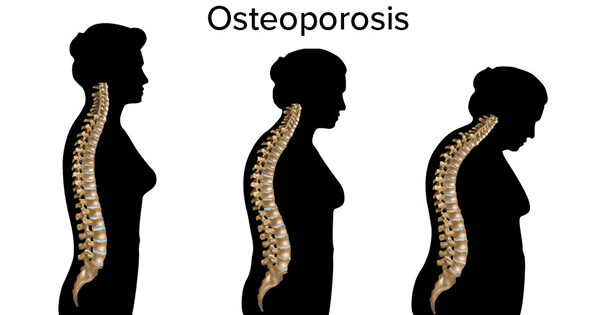 Ayurveda Treatment for Osteoporosis