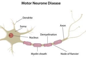 Motor Neuron Disease