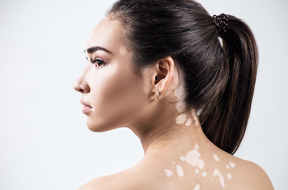 Ayurvedic Detoxification Techniques for Vitiligo Management