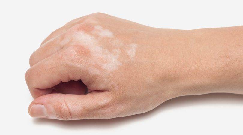 Understanding Vitiligo_Ayurvedic Approaches to Skin Health and Pigmentation