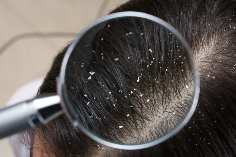 Ayurveda Treatment for Dandruff