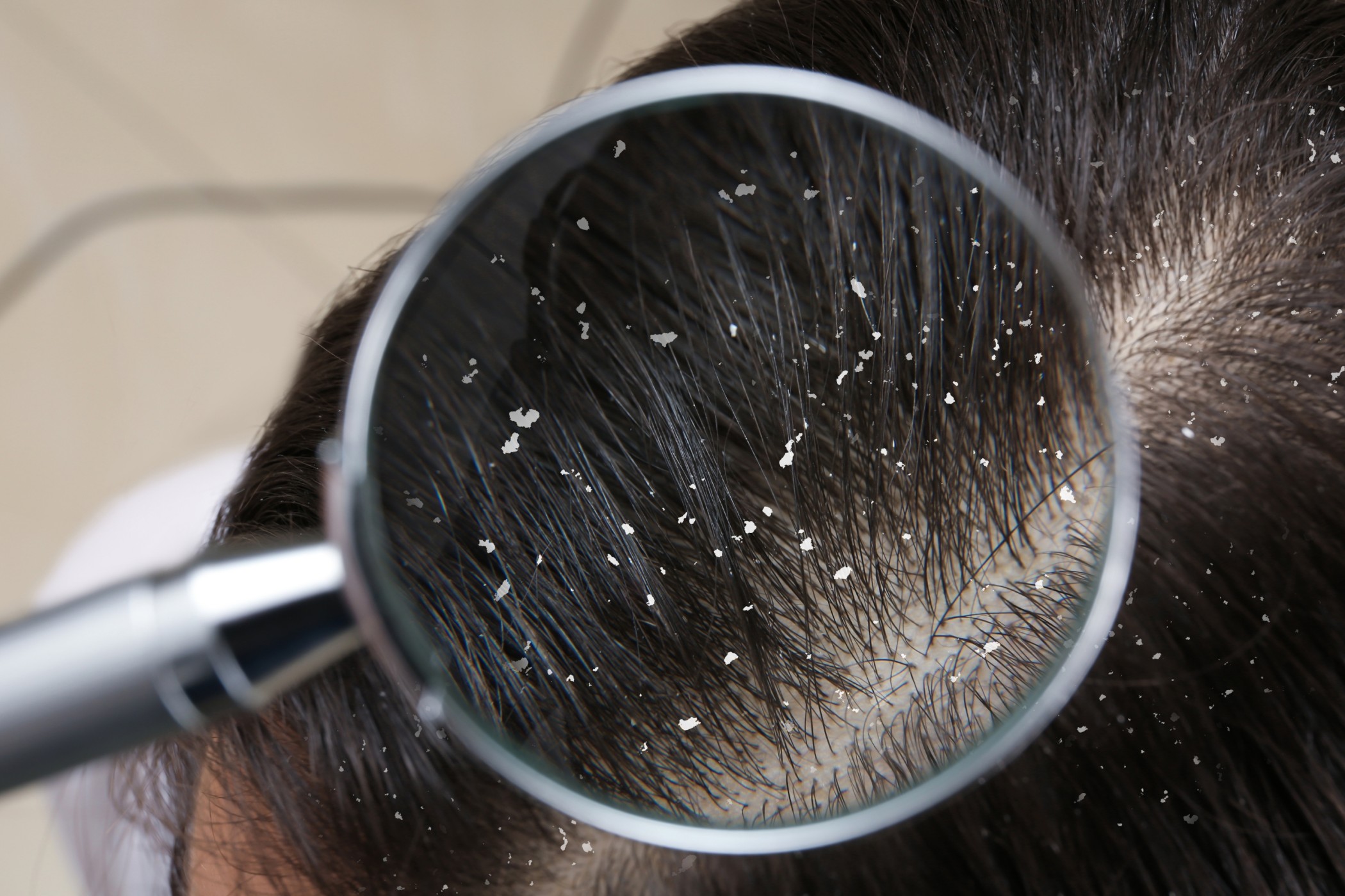 Ayurveda Treatment for Dandruff