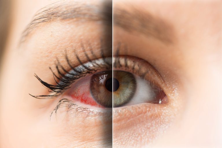 Ayurvedic Treatment For Eyes