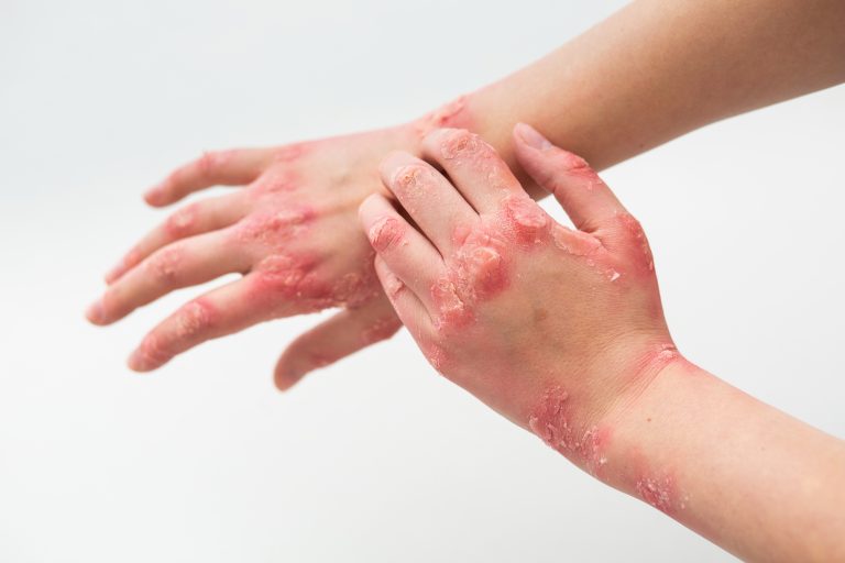 Ayurveda Treatment for Psoriasis